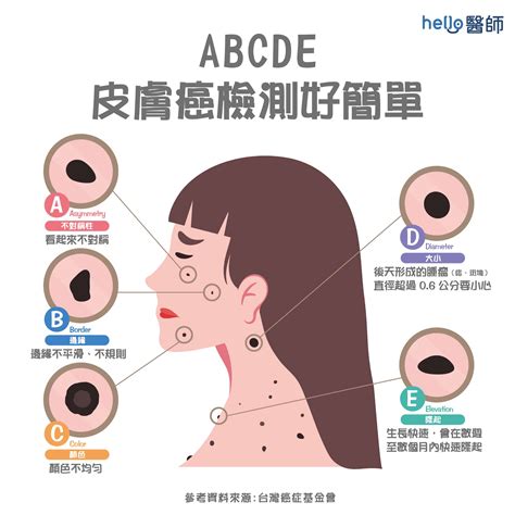 脖子痣長毛代表什麼|痣形成的原因？痣長毛、痣變多變大是痣病變？5招判。